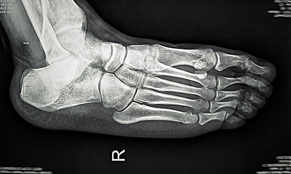 医学x光片脚掌骨骼
