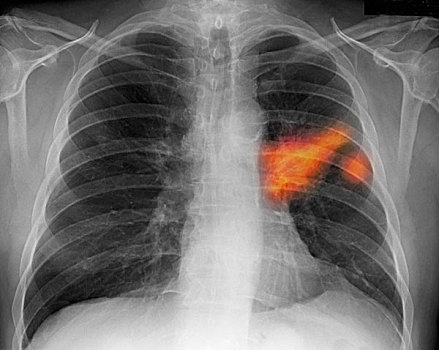 胸部,x光,吸烟,展示,肺,致癌