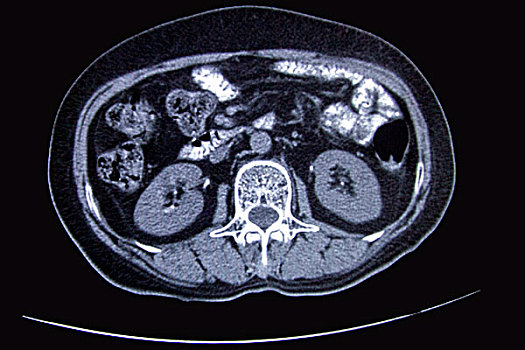 ct扫描断层影像图