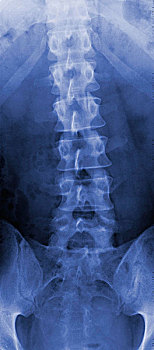 x光照片,脊椎
