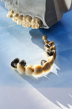 牙齿,桥,陶瓷,后面,颚部,模型