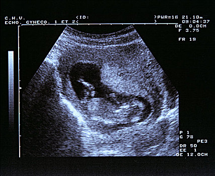 蓝色,超声波扫描,2个月大,胎儿