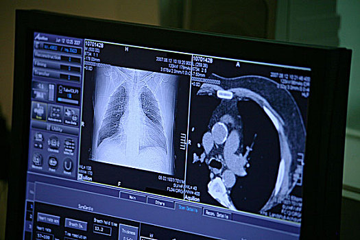 心脏,ct扫描,技巧,检查,房间,调查,男患者,怀疑,动脉,收缩,看,显示器,心脏学,检查室,一个