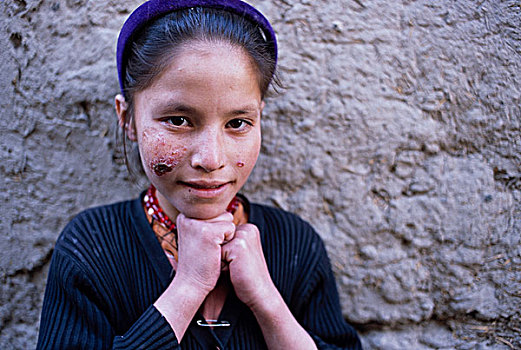孩子,阿富汗,女孩,感染,脸,喀布尔
