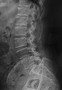 x光,骨盆,脊椎