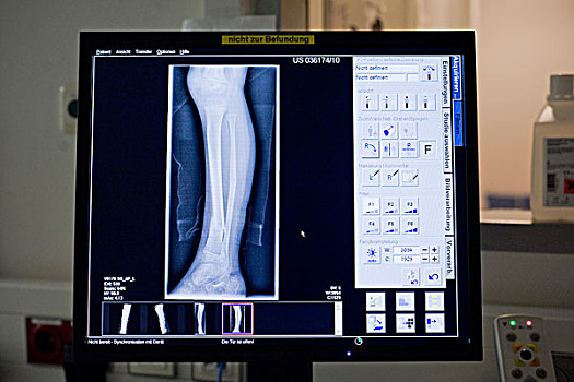 x光,断腿,显示屏,医院