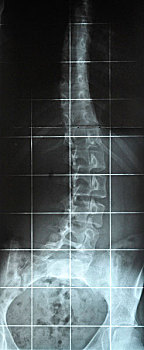 x光,图像,弯曲,脊椎,脊柱侧凸