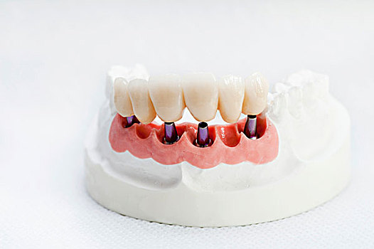 牙齿,冠,颚部,模型