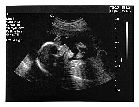 图像,胎儿
