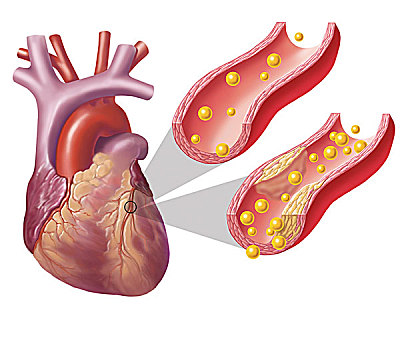 心,动脉,展示,胆固醇,一个,牌匾