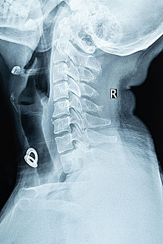 颈椎生理曲度变直的x光片